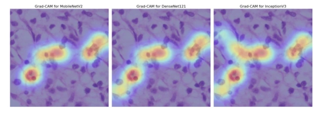 Carcinoma grading model overview